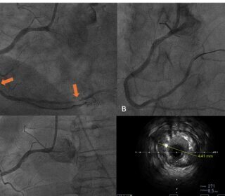 How Interventional Radiology Offers New Treatment Options for Heart Failure