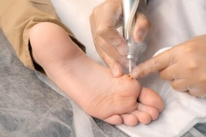 Exploring Home Treatment Options for Plantar Warts