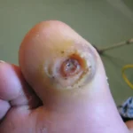 Benefits of Quick Wound Care on Your Feet