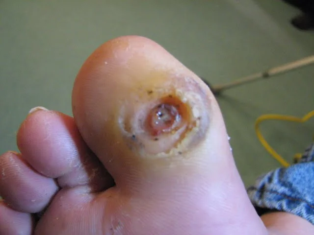 Benefits of Quick Wound Care on Your Feet