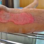 Understanding the Wound Healing Process