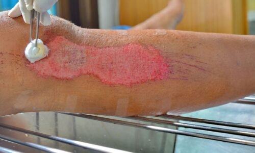 Understanding the Wound Healing Process